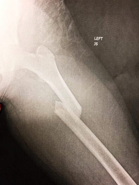 femur break x ray